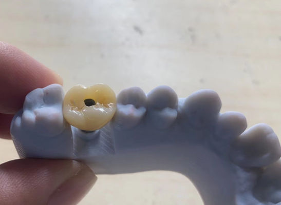 acheter Implant de haute précision à couronne supportée Stable et facile à entretenir fabrication en ligne