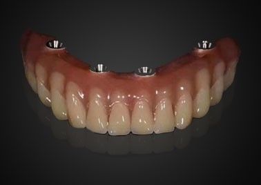 acheter Remplacement d'implant dentaire personnalisé couronne résistante à l'usure pour une utilisation à long terme fabrication en ligne