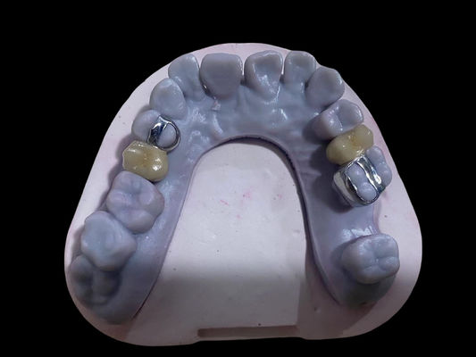 acheter Couronnes en porcelaine en alliage dentaire à couronne PFM de haute précision fabrication en ligne