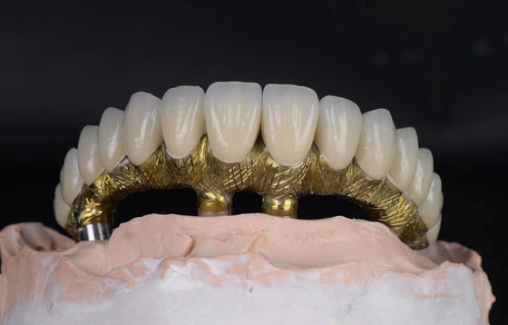 acheter Les implants dentaires et les couronnes en alliage de titane sont naturels et résistants à la corrosion. fabrication en ligne