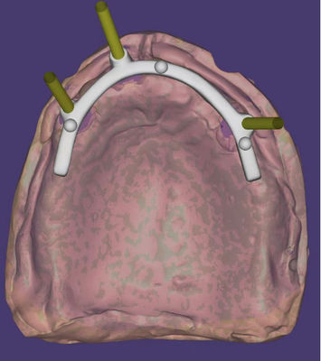 acheter Conception CAD-CAM dentaire personnalisée haute précision pour une barre implantée fabrication en ligne
