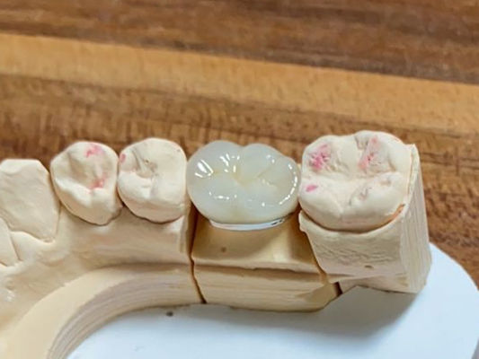 Haute esthétique couronne PFM Cocr alliage de porcelaine fusionnée à la couronne métallique