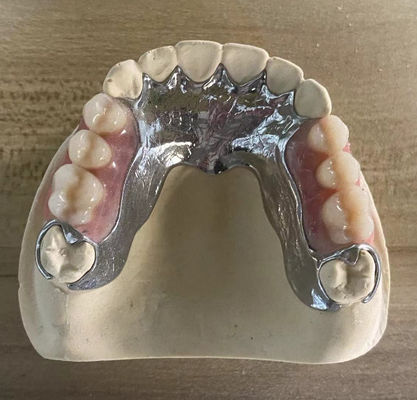 Dentures partielles métalliques coulées à haute résistance