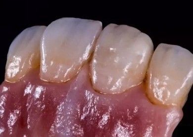 German Amanjilbach Zirconia couronne dentaire haute densité avec personnalisation