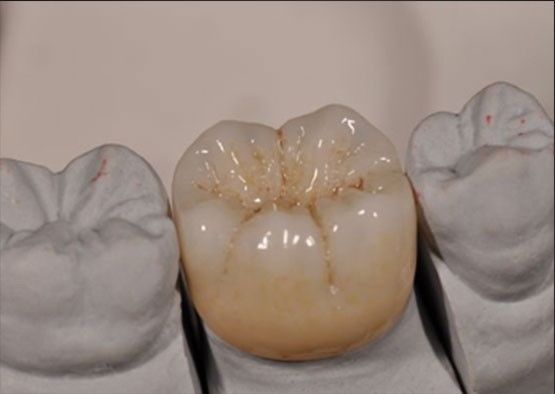 Haut esthétique Noritake Zirconia couleur naturelle stable pour la couronne complète de zirconia
