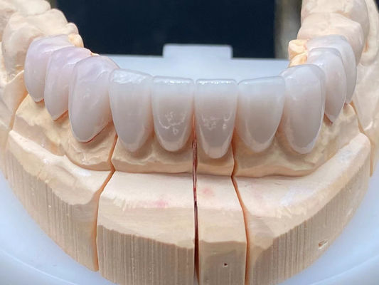 Laboratoire dentaire E Max Couronne céramique haute translucide résistant à la corrosion