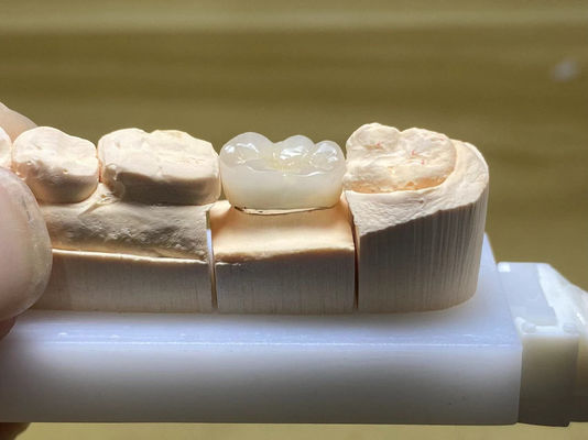 Résistance aux taches PFM couronne en céramique réglable avec la forme des dents naturelles