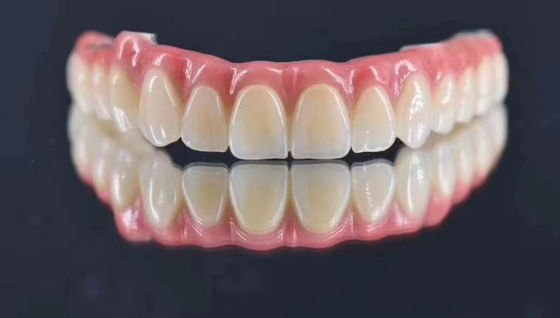 Laboratoire dentaire implant personnalisé soutenu par une couronne métallique naturelle à la recherche de stabilité à long terme