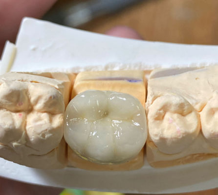 Porcelaine PFM dentaire solide et esthétique fondue dans une couronne métallique en dentisterie