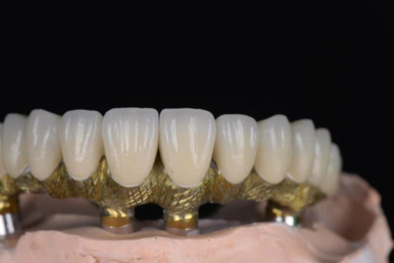 Porcelaine à l'aspect naturel fusionnée à du métal haute précision pour les implants dentaires