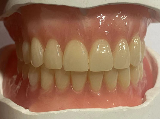 Prothèse partielle amovible hypoallergénique personnalisée de couleur rose