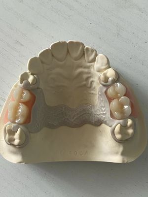 Prothèse partielle acrylique réglable avec ajustement sécurisé