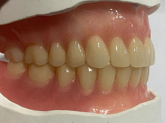 Des dents en acrylique personnalisées à l' apparence naturelle pour une rétention optimale