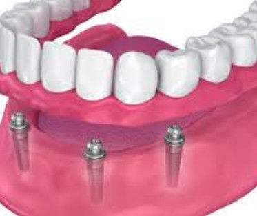 Appareil à bille d'implant personnalisable