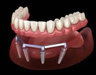 Barre d'implant de dentition sablée pour une esthétique translucide et naturelle