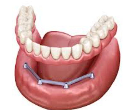 Barre d'implant translucide à vis retenue Barre d'implant de surface polie