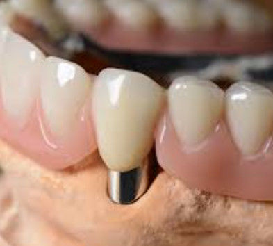 Couronne dentaire télescopique personnalisable haute précision avec apparence naturelle