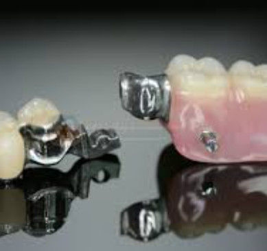 Haute souplesse Mk1 fixation dentaire haute précision et sécurité d'utilisation